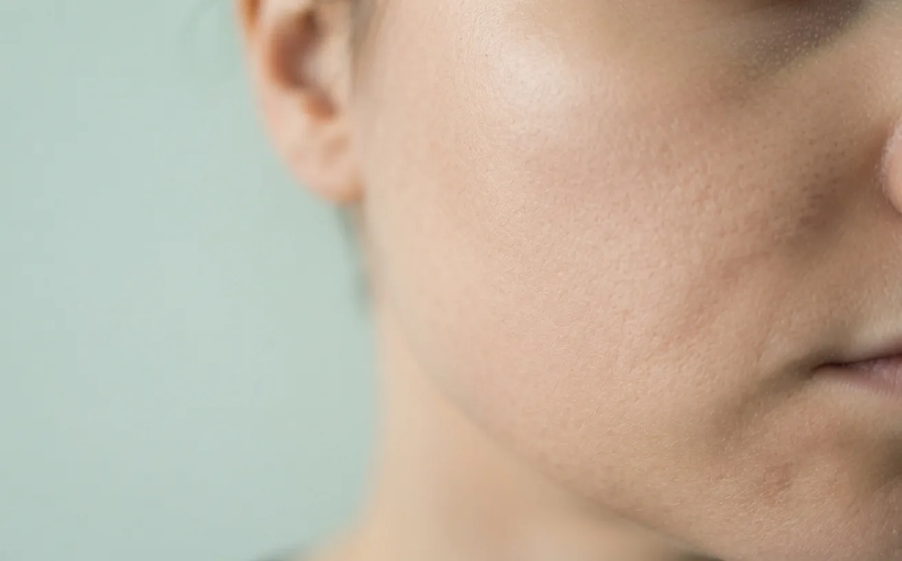 The same cheek and jawline after treatment — clearer, more even skin in identical lighting