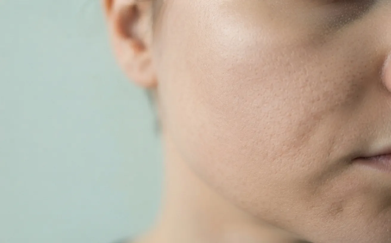 A close view of a cheek and jawline showing uneven tone and visible texture before treatment